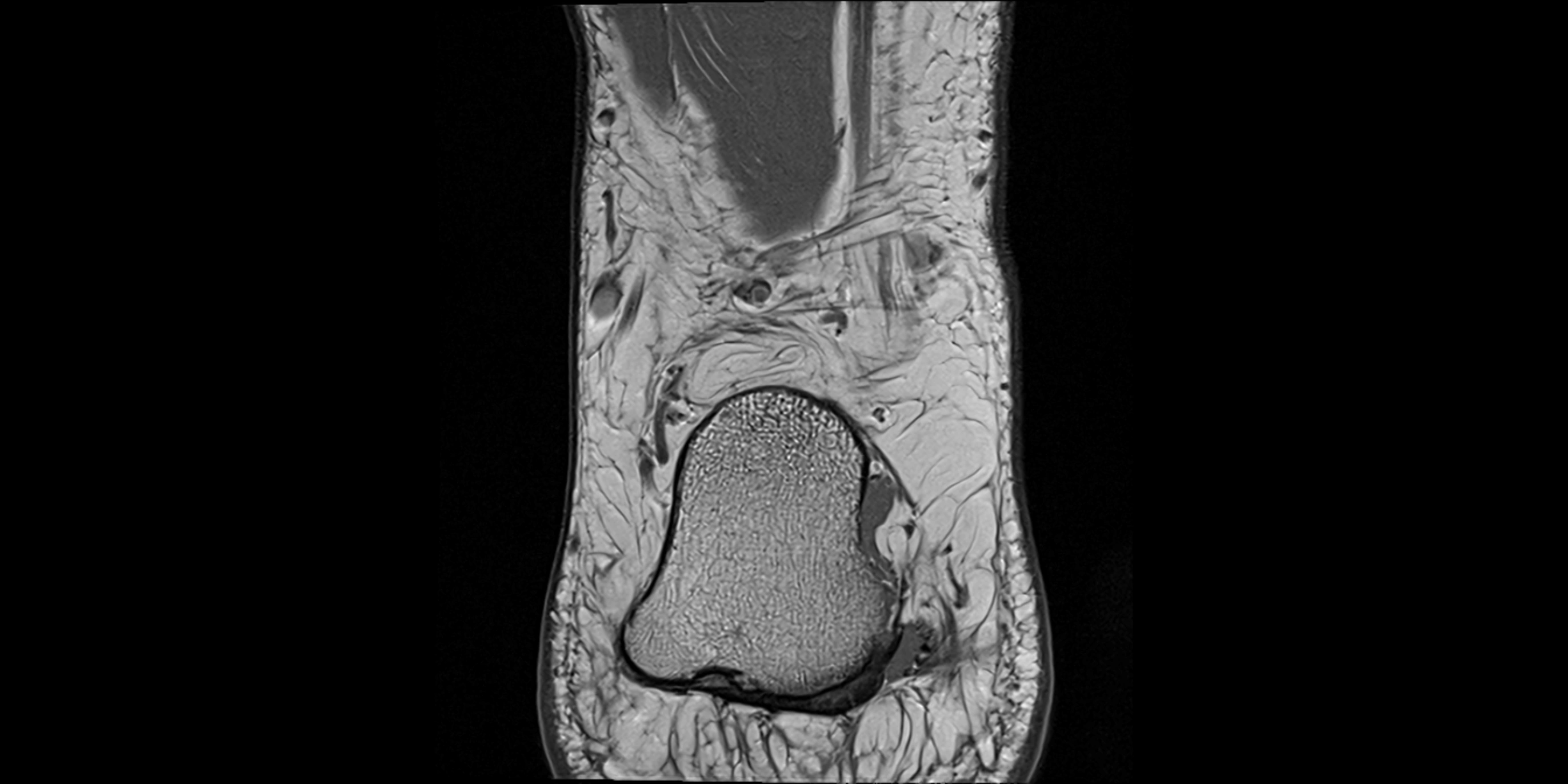 MRI Ankle coronal ligaments cross sectional anatomy 3T  radiology  image-img-00001-00024.webp